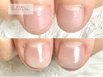 グレースレディ/【長さ出し/フィルイン/深爪】