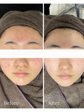 ニキビケア研究所 高崎店/BEFORE AFTER