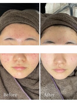 ニキビケア研究所 高崎店/BEFORE AFTER