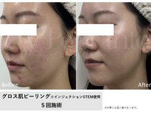 グロウラ(GrowRa)の雰囲気（グロス肌ピーリングエステを５回施術でニキビが改善されている）