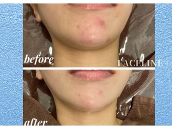 シンメトリー 銀座店/ハーブピーリング