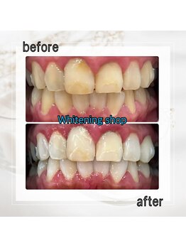 ホワイトニングショップ 亀戸店/【亀戸】美白ホワイトニング