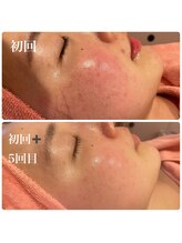 ヒメミ(Himemi)/ＢＢＬ光フェイシャル