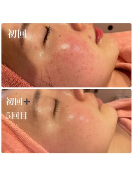 ヒメミ(Himemi)/BBL光フェイシャル