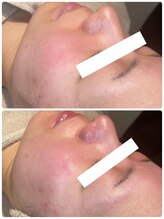 ディオーネ 春日井勝川店(Dione)/毛穴洗浄☆ビフォーアフター