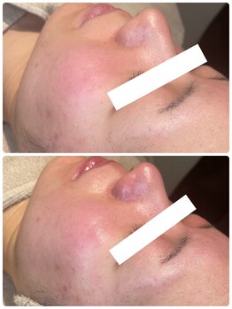 ディオーネ 春日井勝川店(Dione)/毛穴洗浄☆ビフォーアフター