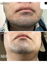 プラウディア(PROUDIA)/ヒゲ脱毛/脱毛/水戸脱毛/赤塚