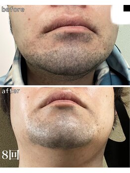 プラウディア(PROUDIA)/ヒゲ脱毛/脱毛/水戸脱毛/赤塚