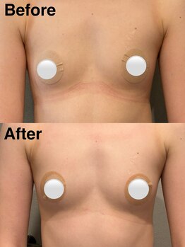 リレイスフクオカ(RelaceFUKUOKA)/バストアップ脂肪増加剤