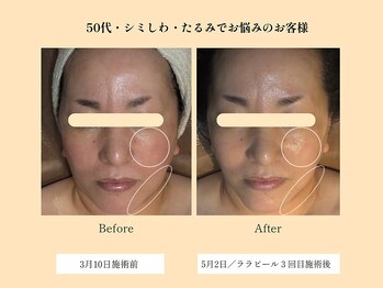 パンセリーノ(Panselinos)/年齢肌対策ララピール