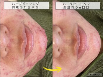 育肌美研 自由が丘サロン/ニキビケア|ハーブピーリング