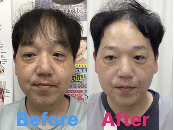 ふたば接骨院 豊橋/男性にも人気の美容鍼!