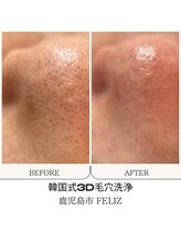 フェリス(FELIZ)/韓国式3D毛穴洗浄