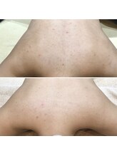 ヴィヴィ(ViVi)/HAAB REPRO　背中ハーフ