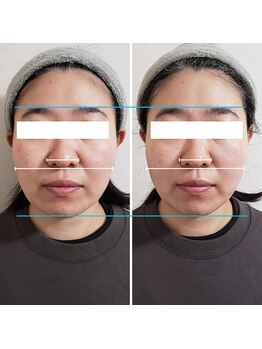 きしの美容整体院/フェイシャルリフトケアBA