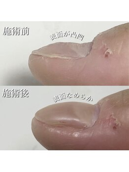 リリー/施術後は表面なめらか！