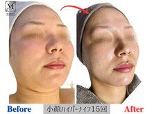 マリス(MARISS)/小顔ハイパーナイフ15回【小顔】