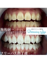 ホワイトニングサロン 福岡天神店/ホワイトニング