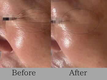 ルミライズ(lumirise)/〈1回目での効果〉