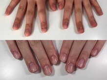 エスネイル(S-nail)/深爪矯正/自爪育成