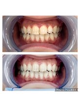 エクシアホワイト SOKA(ecxia white)/