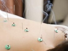 トイトイトイ(toitoitoi)/鍼とお灸で心身ともにすっきり