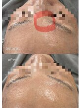 フットミー(foot mii)/水光ピール