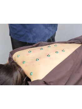 鍼灸施術を受けたい