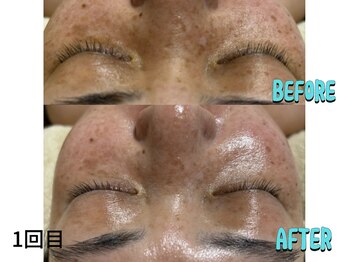 リボーン(be reborn)/一回目で全体的にくすみが取れ、