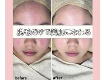 ベルミーランド 浜松天王/脱毛Before→After