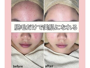 ベルミーランド 浜松天王/脱毛Before→After