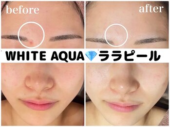 ホワイトアクア 柏店(WHITE AQUA)/ララピール/ニキビケア/赤みケア