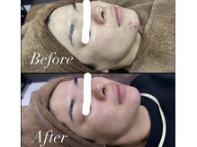 剥けないハーブピーリングでニキビ肌を改善☆☆