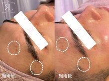 メンズのお肌管理★男性特有のお悩みもお任せ下さい！