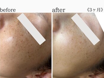 ウィズマツオカ 光の森店/シミ当て放題！