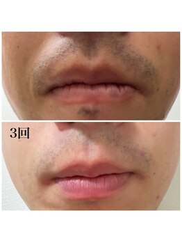 プラウディア(PROUDIA)/ヒゲ脱毛/脱毛/水戸脱毛/赤塚