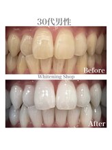 ホワイトニングショップ 広島廿日市店/before&after