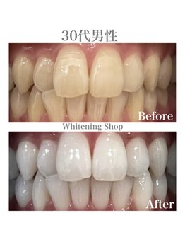ホワイトニングショップ 広島廿日市店/before&after