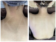 カフー(KAFUU)/産毛にも効果アリ