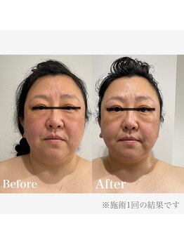 クリア(CLEAR)/小顔美整顔