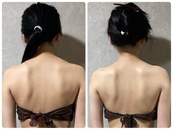 スリーピングビューティー(Sleeping Beauty)/インディバ　肩こり