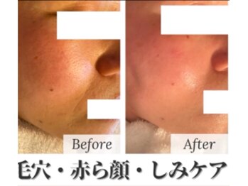 ココ(KOKO)/毛穴目立ちでお悩みの方に