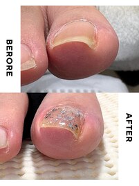 【美爪育成】《フット》巻き爪