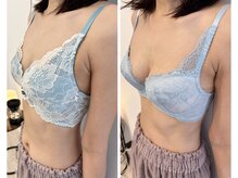 リソラ(risora)/バストアップ症例