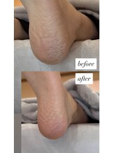 フットミー(foot mii)/１回目