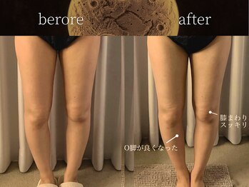 リムーン(REMOON.)/施術後の効果★