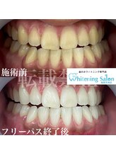 ホワイトニングサロン 福岡天神店/ホワイトニング
