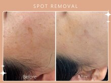 ハノハノ 八代店(HANO HANO)/気になるシミ、何個でもぺろん☆