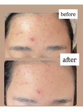 エレーヴ(Eleve)/肌質改善