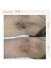 エムケーサロン(Mksalon)/シュガーリング脱毛/ワキ